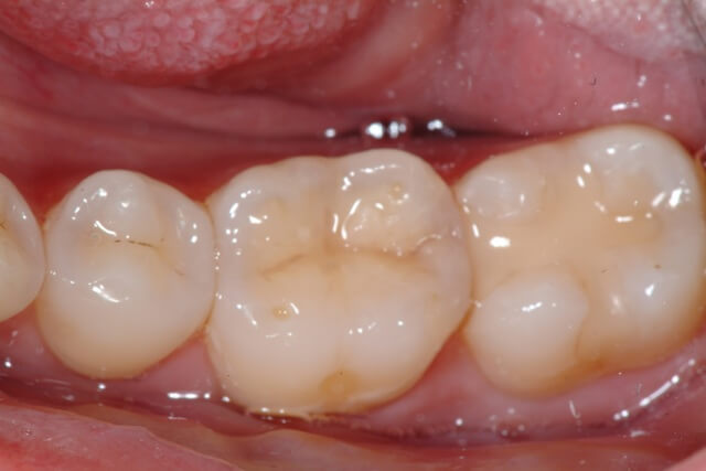 composite restoration with undetectable margins prevent leakage and recurrent decay