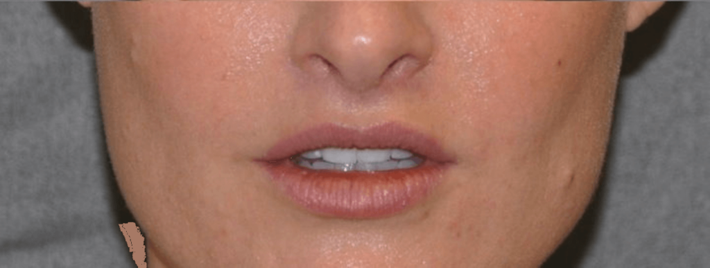 Lip Lift - After