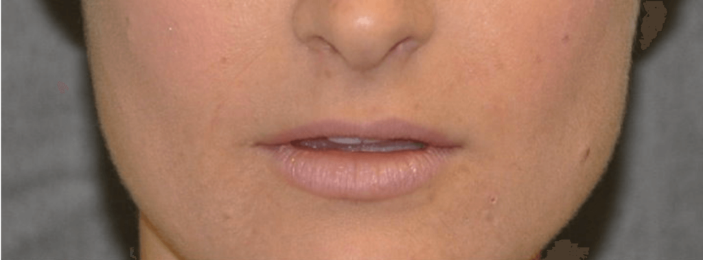 Lip Lift - Before