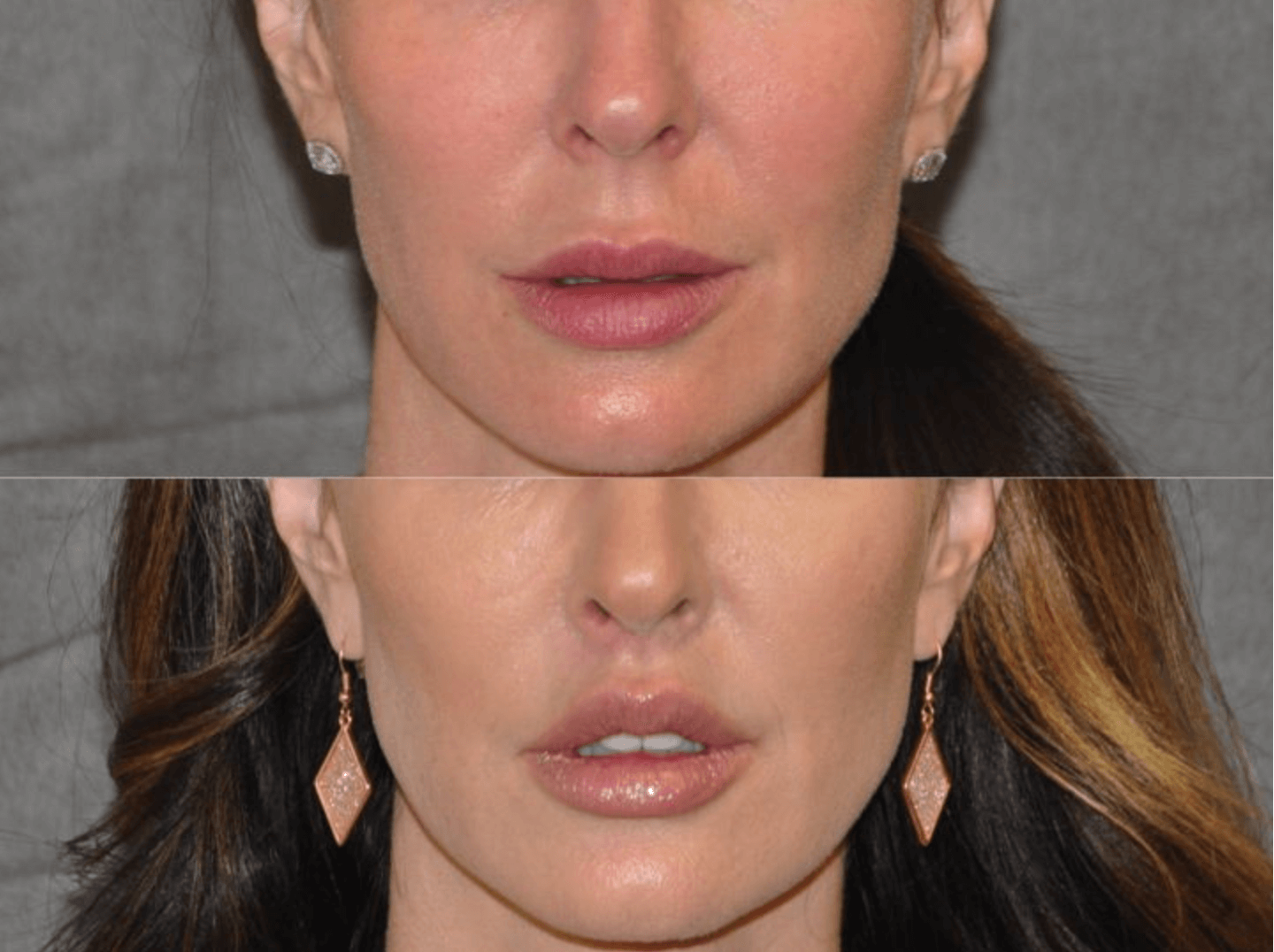 Dental Lip Lift before and after photos