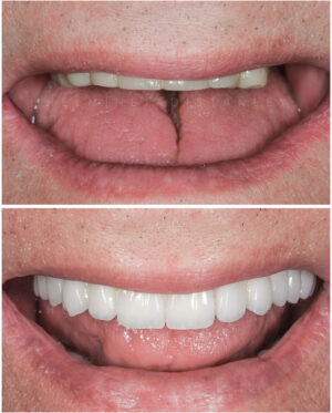 Cosmetic smile makeover before and after of the upper arch.