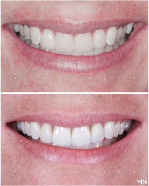 Cosmetic Smile Makeover to replace old un-natural veneers - Before and after