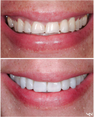 Full Mouth Reconstruction Smile Makeover - Before and After