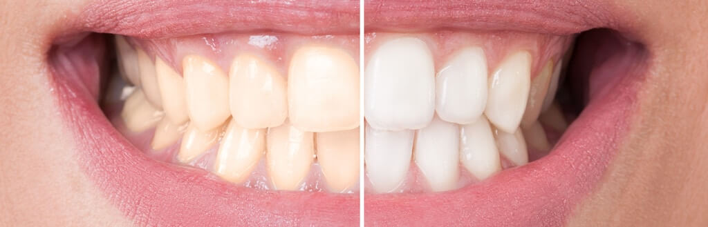 teeth whitening before and after