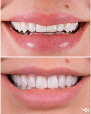 Closeup before & after smile of 10 veneers