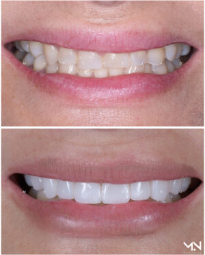 Closeup before & after - smilemakeover- upper