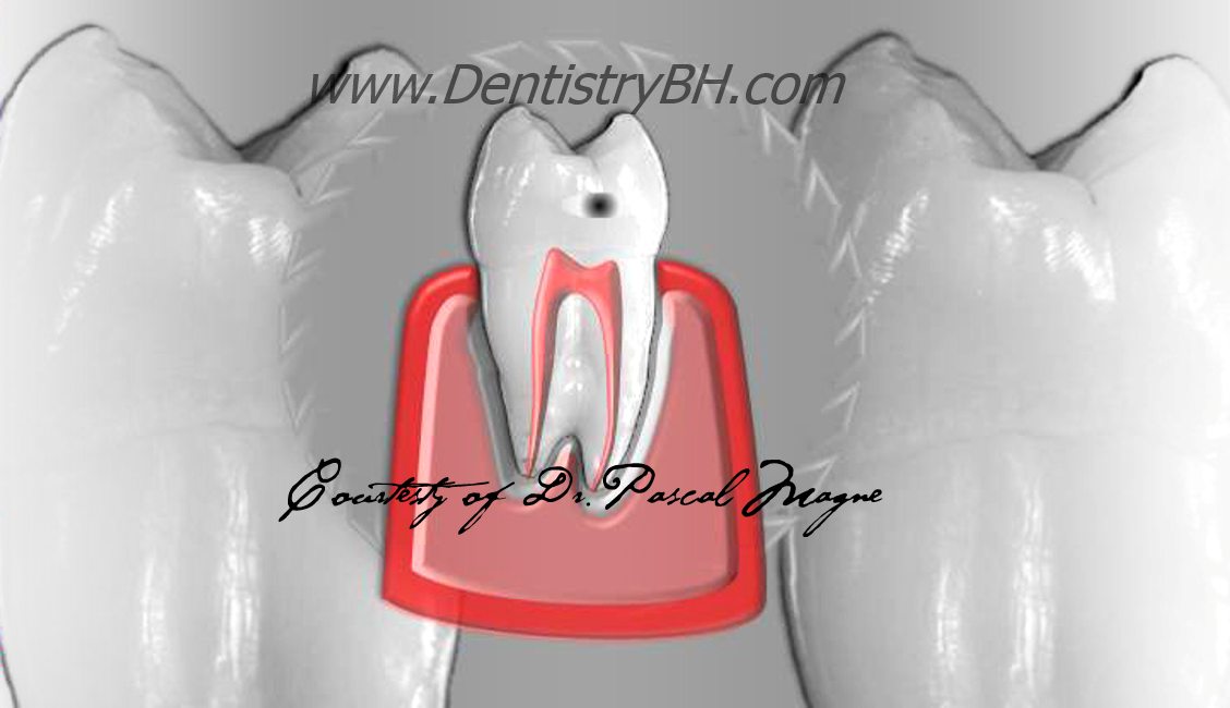 1_Biomimetic-Dentisry-Tooth-Cycle-Death--Cavity