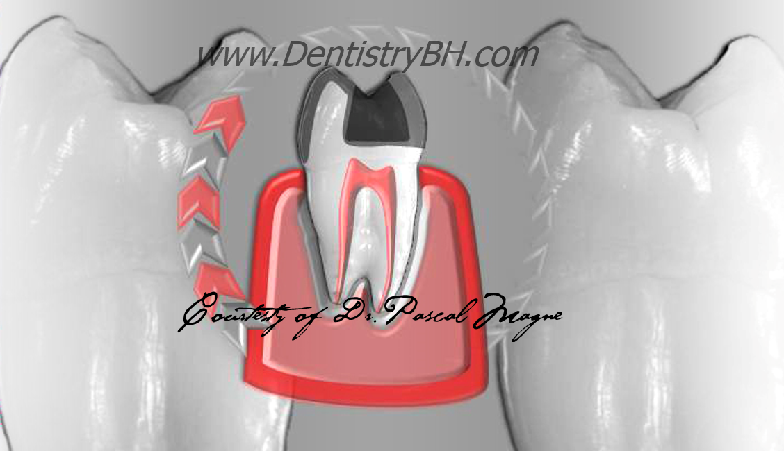 4_Biomimetic-Dentisry-Tooth-Cycle-Death--Crown+Restoration