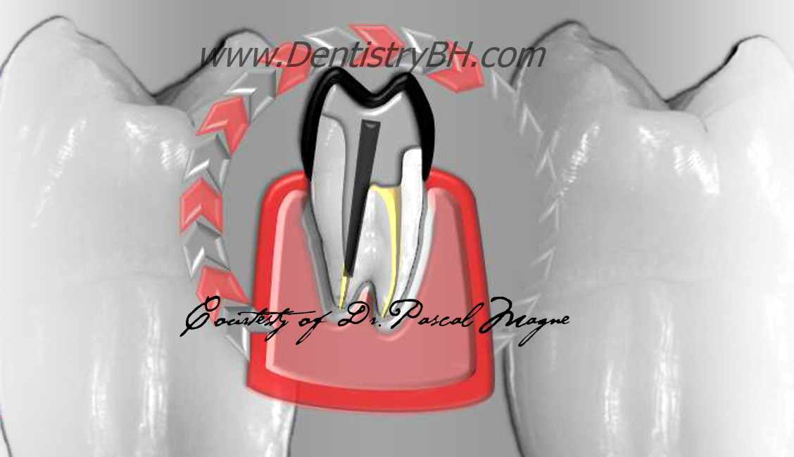 6_Biomimetic-Dentisry-Tooth-Cycle-Death--Crown-Restoration-Post-Build-up