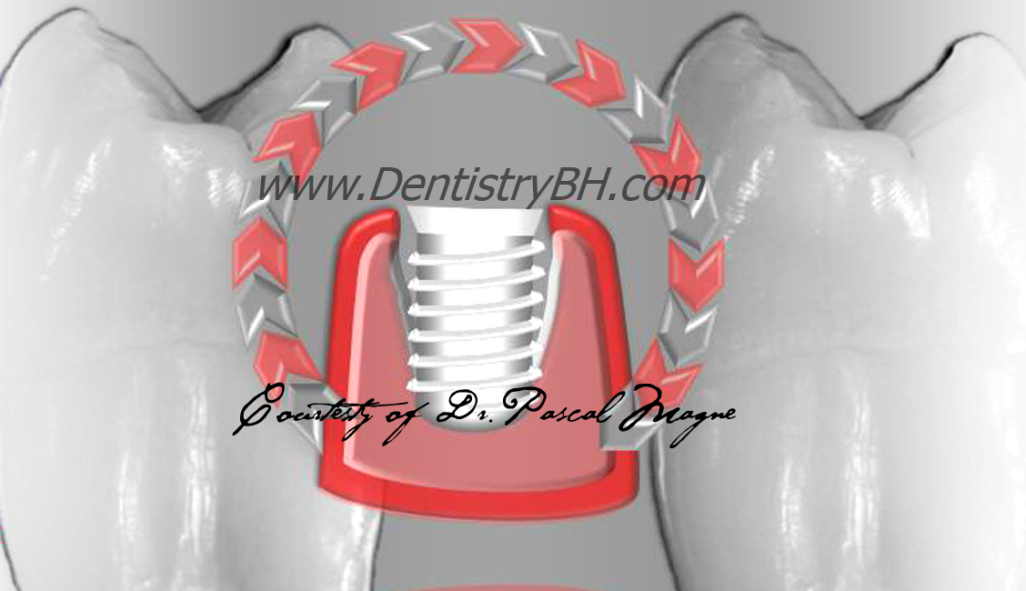 8_Biomimetic-Dentisry-Tooth-Cycle-Death--Implant