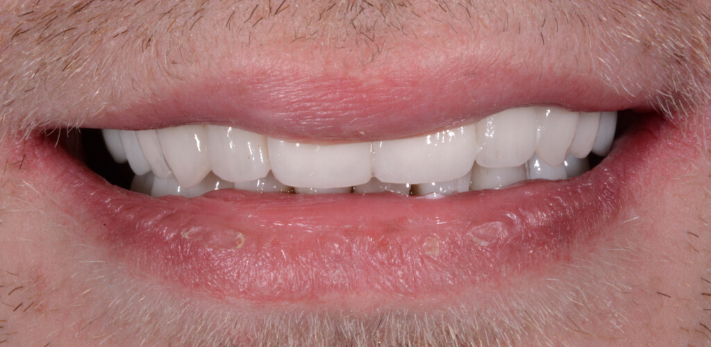 Dental Rehabilitation & Drug Abuse Beverly Hills Dentists