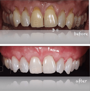 Pinhole Surgical Technique before and after