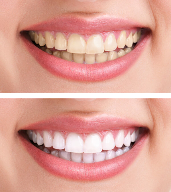 Typical results achieved with custom teeth whitening trays. 