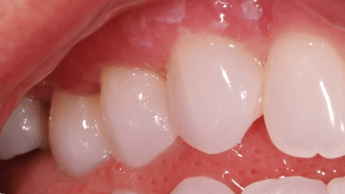 After Pinhole Surgical Technique for Gum Recession