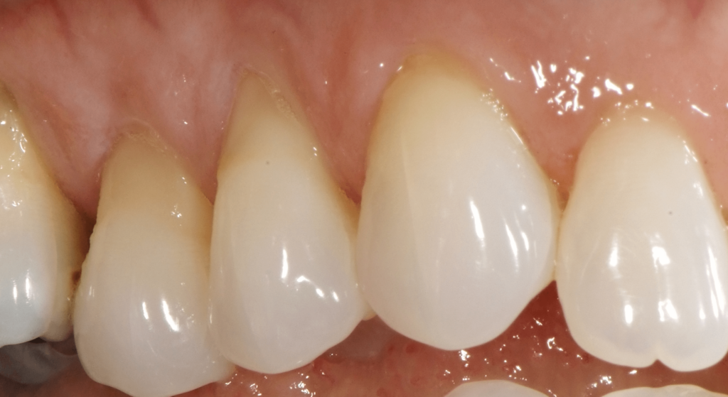 Before Pinhole Surgical Technique for Gum Recession