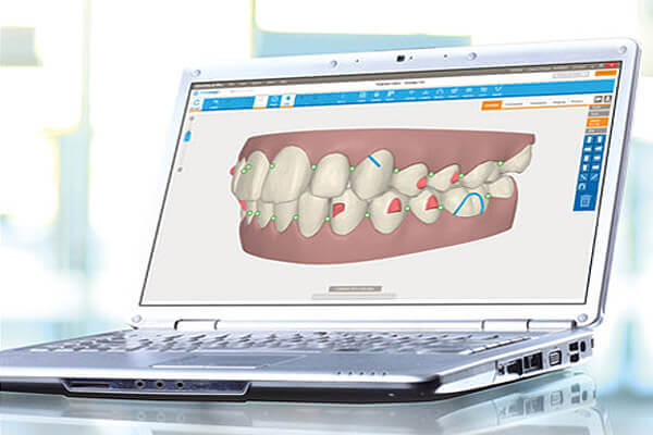 Invisalign Clincheck Pro software displayed on a laptop. 