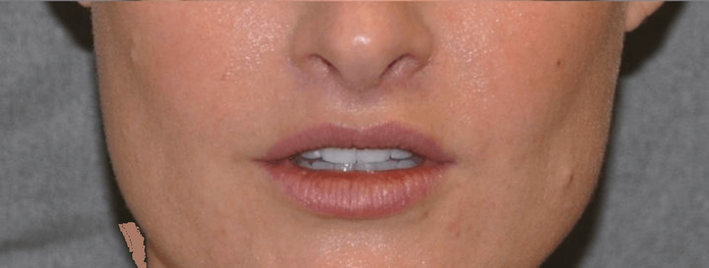 Beverly Hills Lip Lift Dentistry West Hollywood Lip Lifts Dentist
