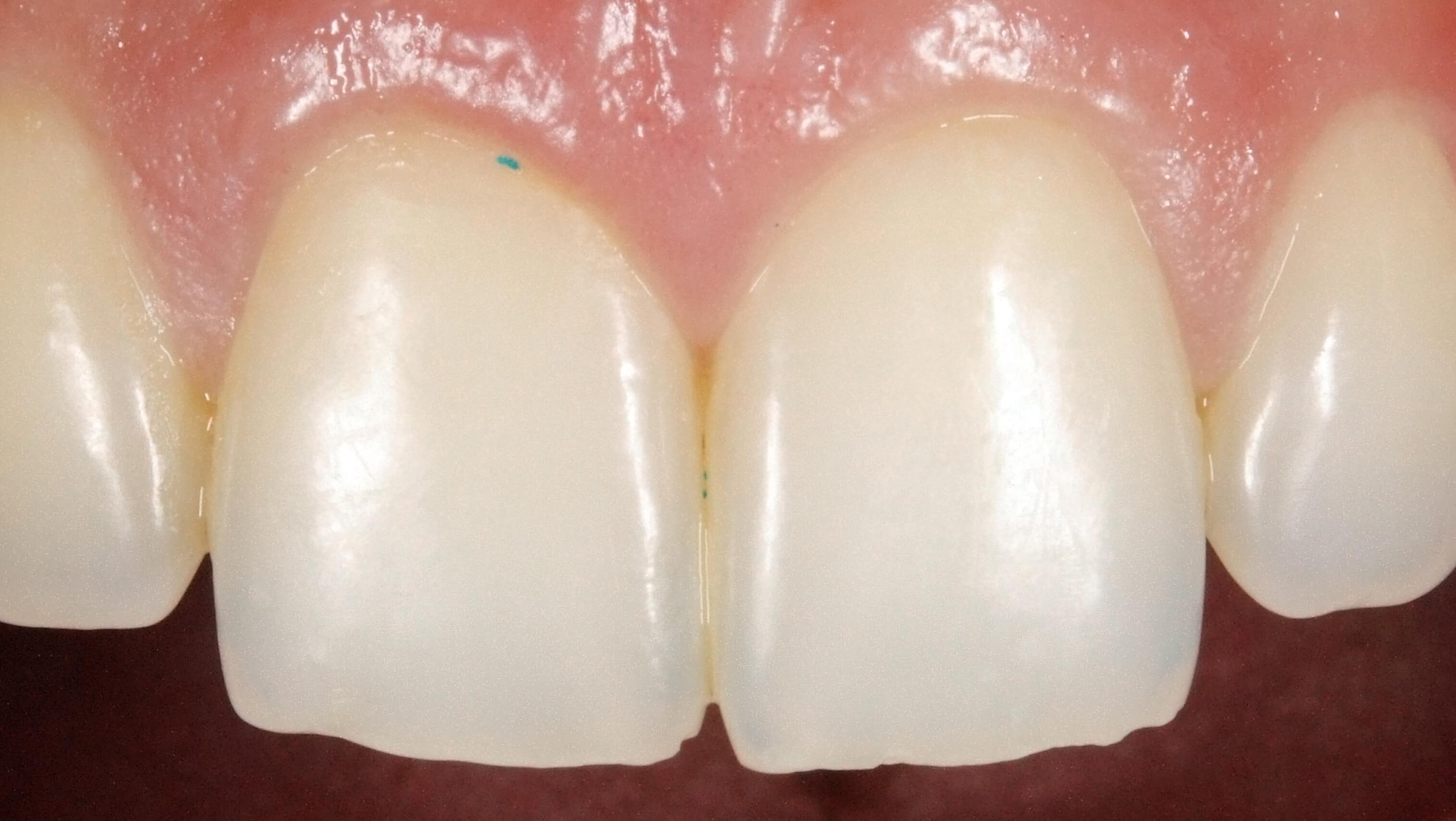 Notice the Microbeads Stuck in the gum line and between the two front teeth.