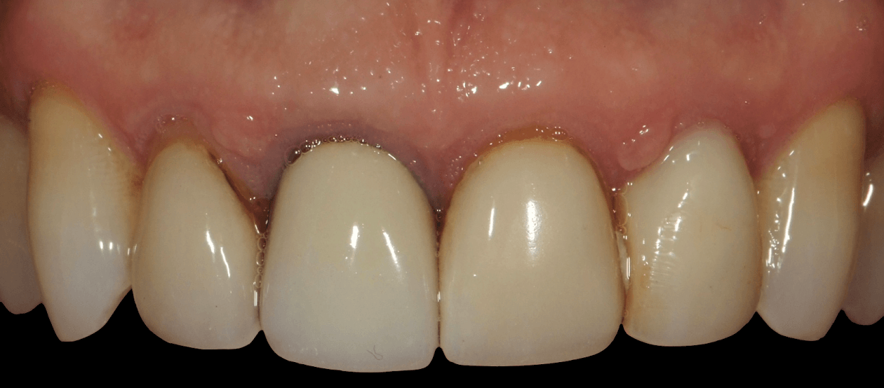 Low quality porcelain fused to metal restorations appear bulky and opaque. These restorations are replaced with extremely natural porcelain restorations by a master ceramist with extensive training, education and experience.