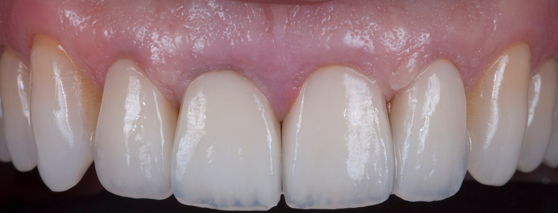 Porcelain crowns