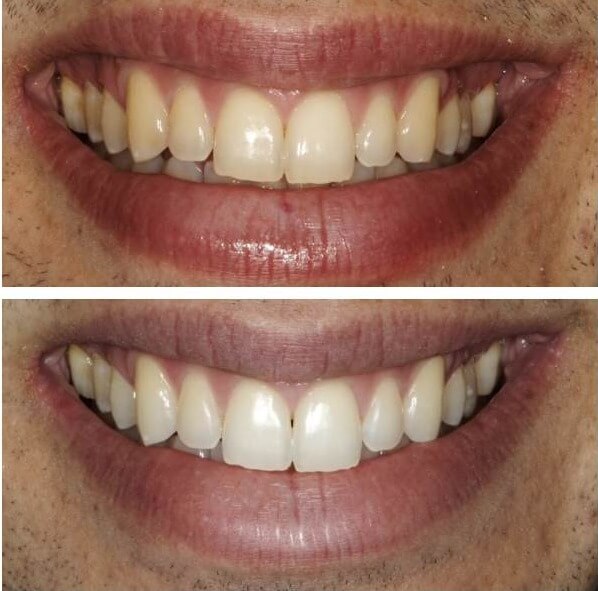2 week teeth-whitening results using 10% carbamide peroxide gel overnight