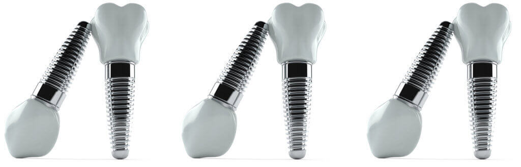 Dental Implants Beverly Hills CA 90210