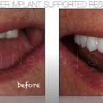 Dental Implants supporting a cosmetic full upper restoration