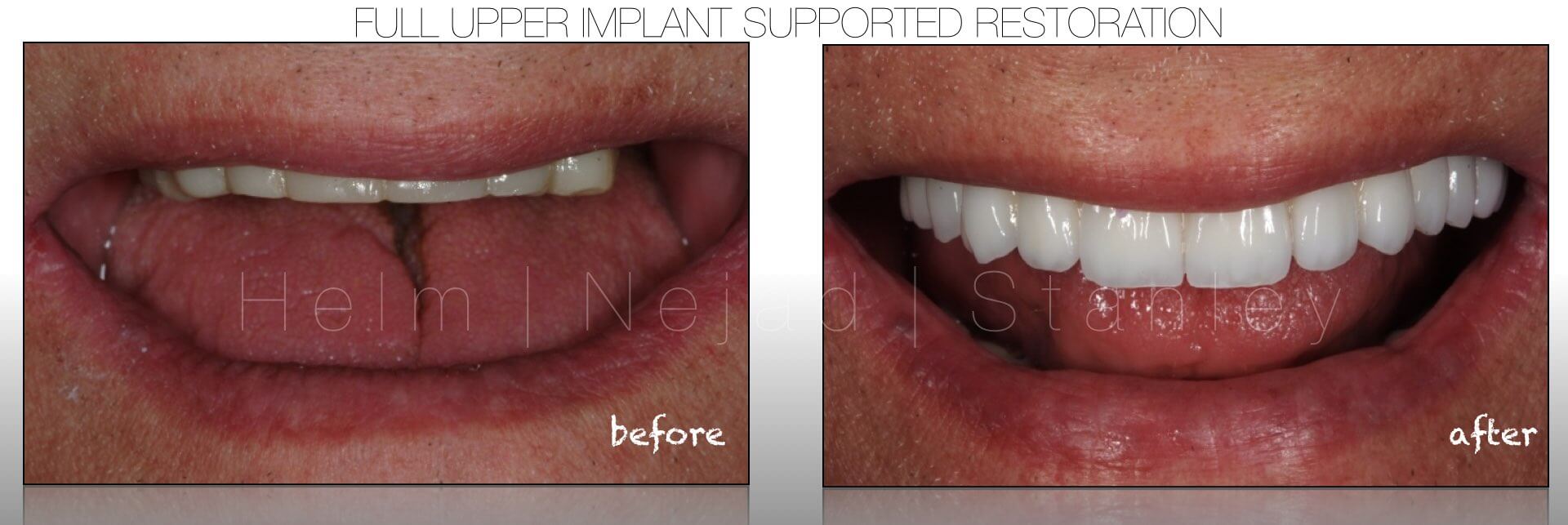 Dental Implants supporting a cosmetic full upper restoration