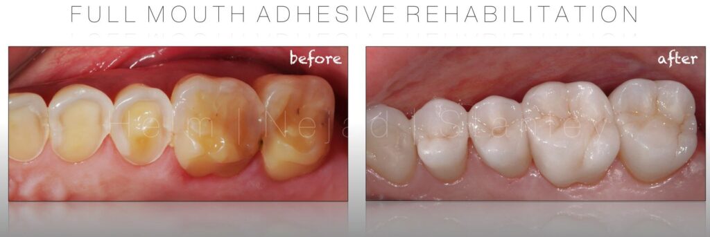 Biomimetic Dentistry- Porcelain onlay restorations - Full mouth adhesive rehabilitation