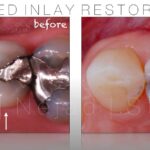 biomimetic dentistry inlay