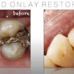 biomimetic dentistry - bonded only restoration