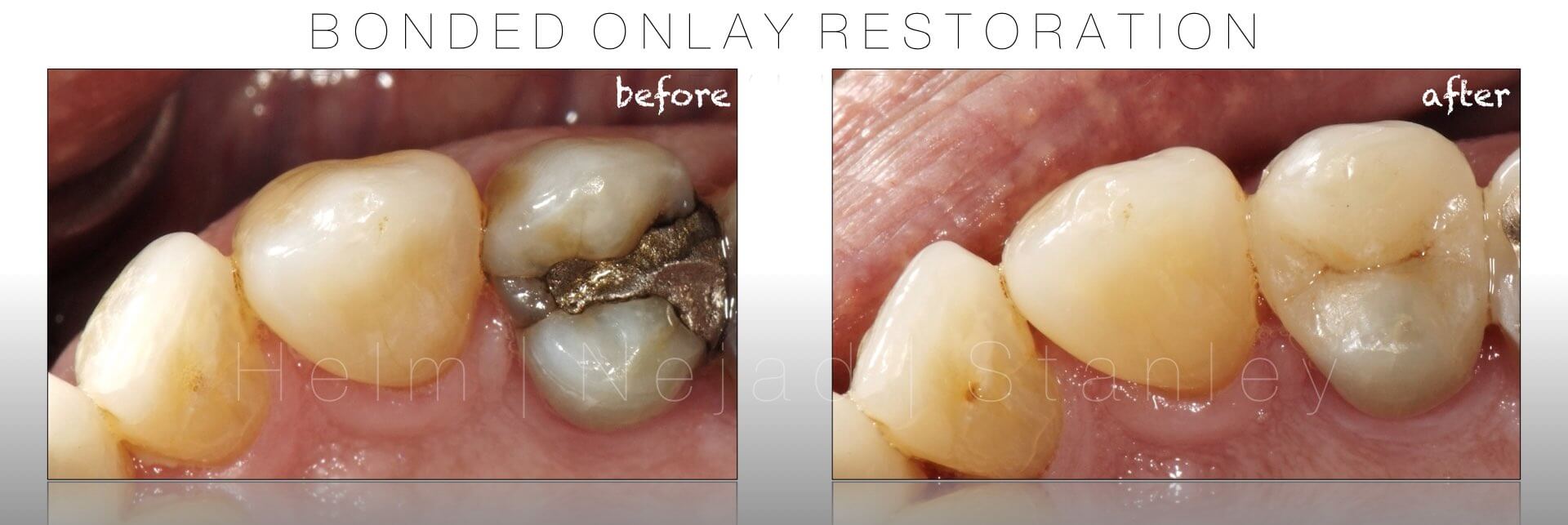 biomimetic dentistry - bonded only restoration