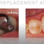 biomimetic dentistry - crown replacement and inlay
