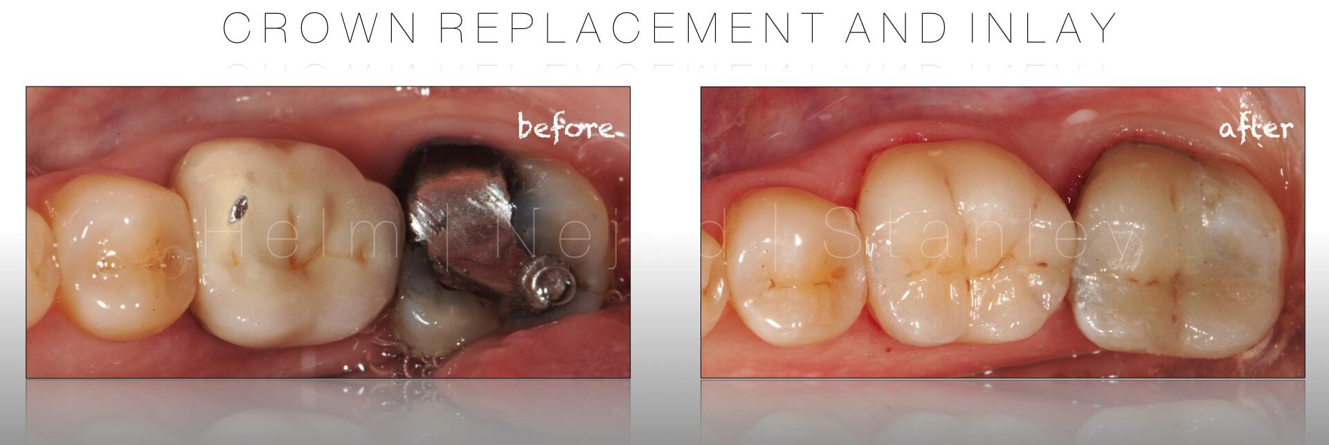 biomimetic dentistry - crown replacement and inlay