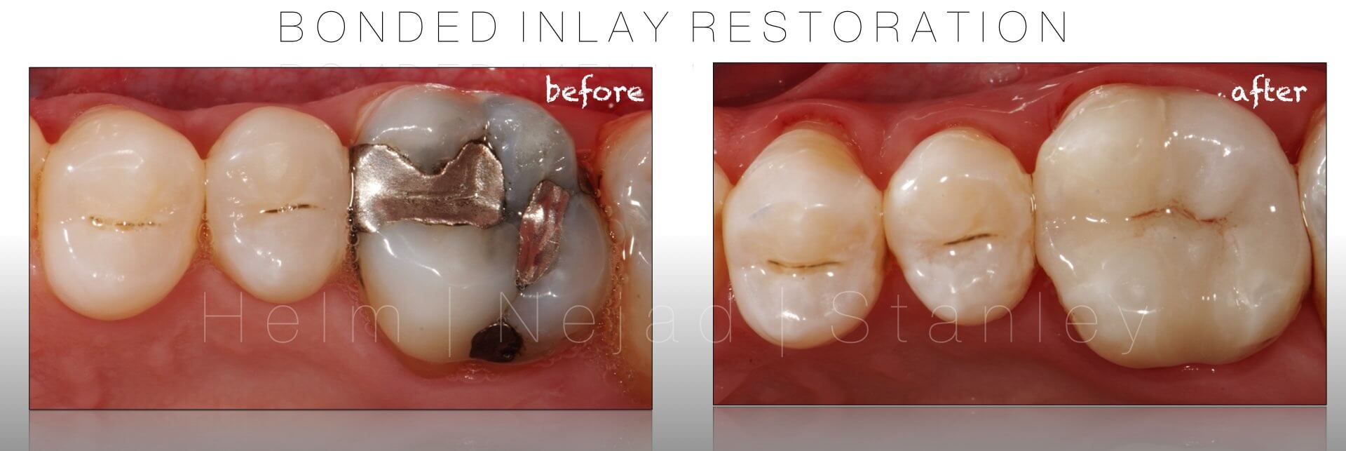 biomimetic dentistry inlay - bonded inlay restoration