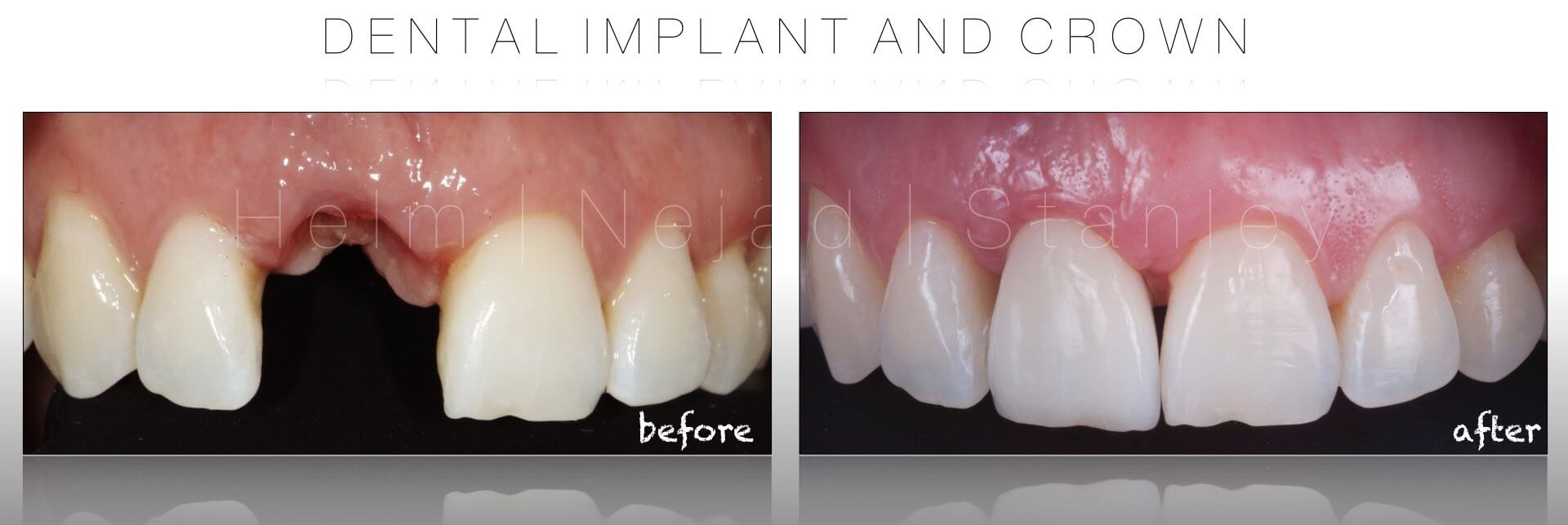 dental implant crown