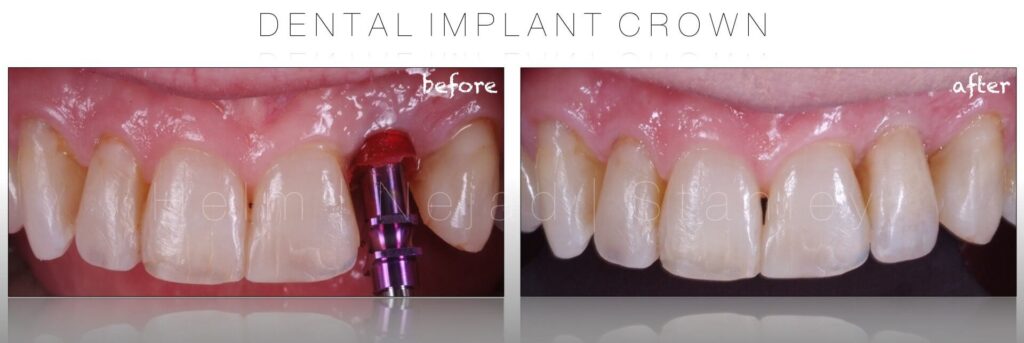 dental implant crown