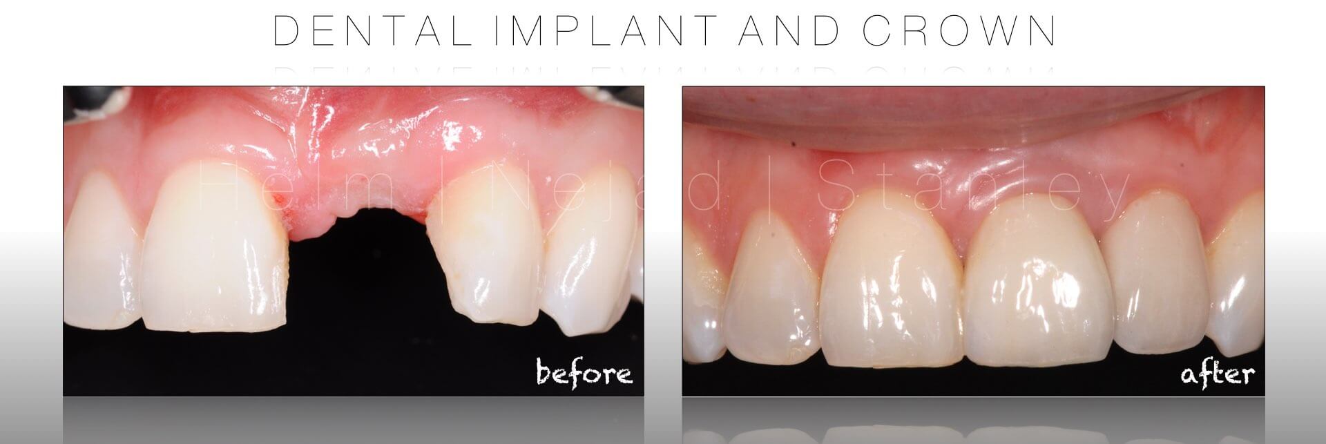 dental implant crown