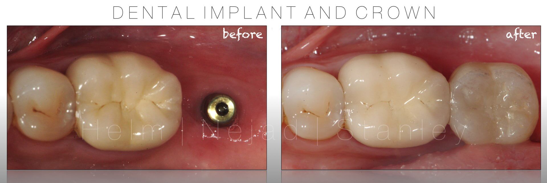 dental implant crown