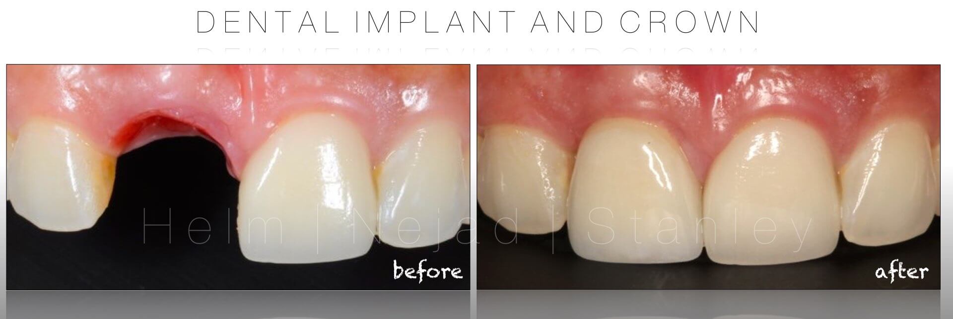 dental implant crown