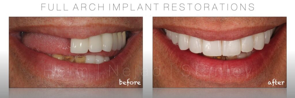 full arch dental implants