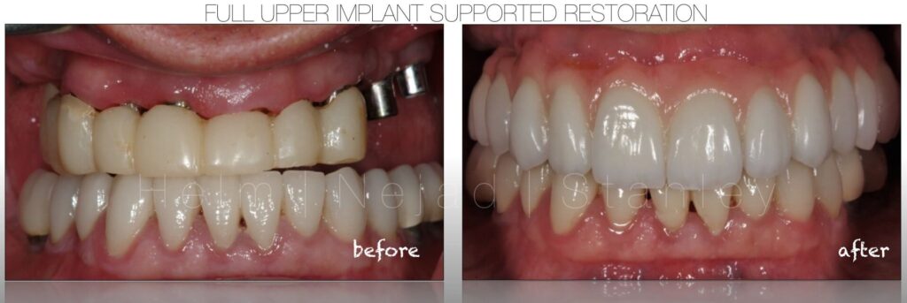 Implant Dentistry - Full Implant Supported Dental Restoration