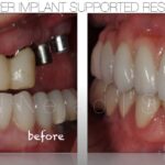 Implant Dentistry - Full Implant Supported Dental Restoration