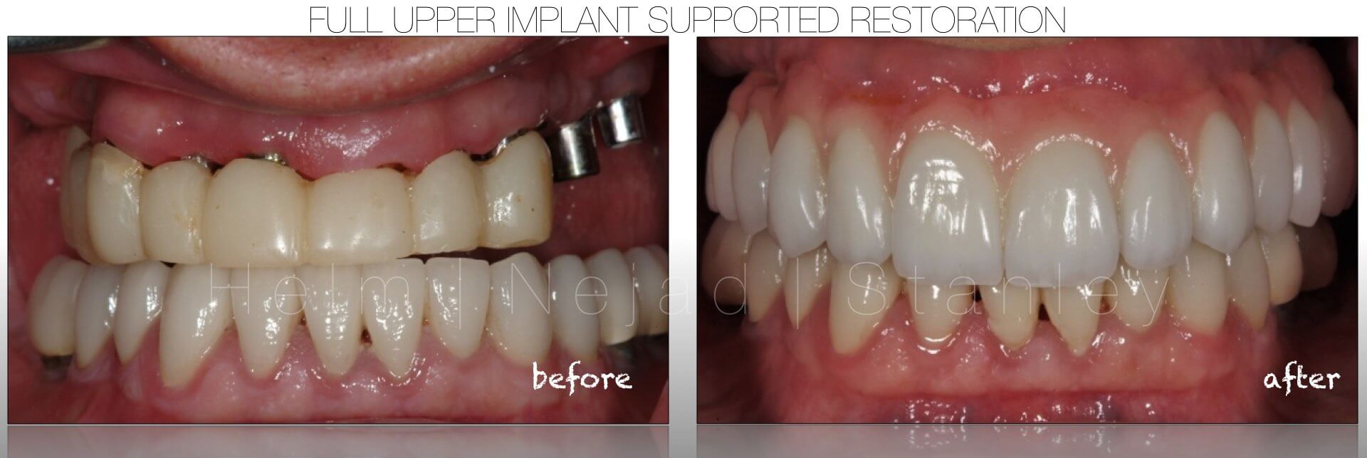 Implant Dentistry - Full Implant Supported Dental Restoration