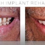 full mouth implant restoration beverly hills