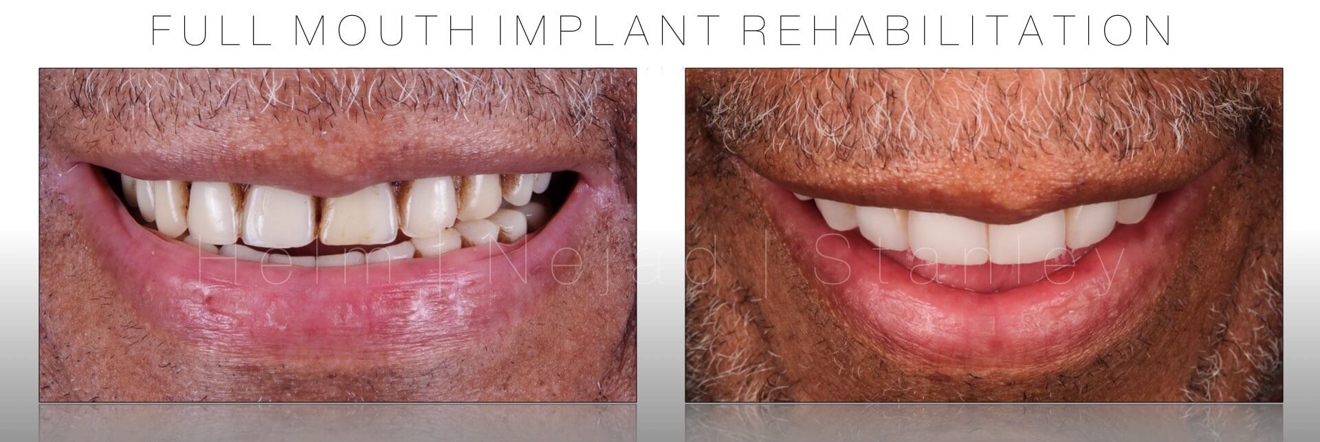 full mouth implant restoration beverly hills