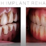 beverly hills before and after dental implants