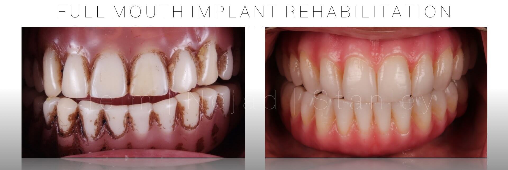 beverly hills before and after dental implants