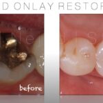Onlay-Biomimetic-Before-After