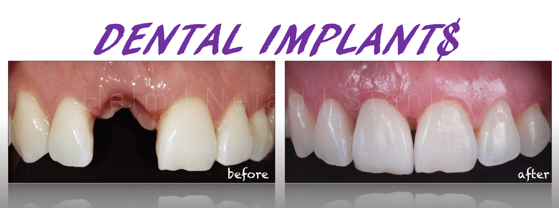 how much are dental implants?